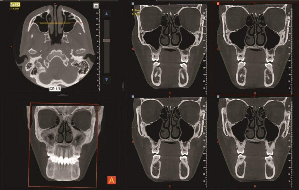 3D zobrazenie CBCT
